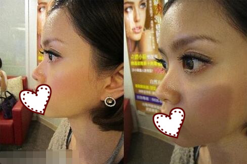 鄭州蘊(yùn)美整形玻尿酸隆鼻案例分享，效果即刻看得見(jiàn)