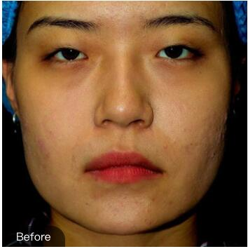 重慶華美下頜角整形術(shù)后兩個(gè)月效果反饋