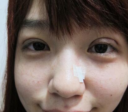 宜昌蕾帝整形張景雷雙眼皮一周效果