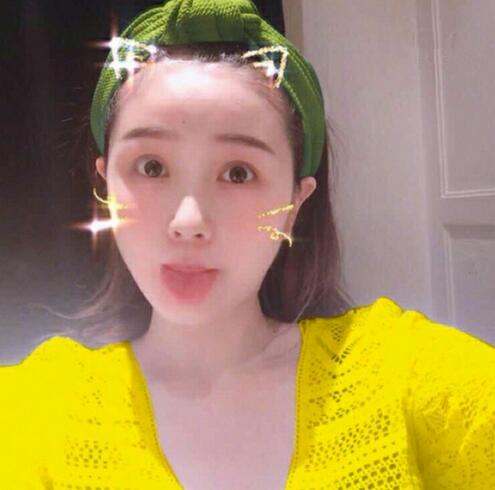 重慶美聯(lián)臣下頜角整形術(shù)后三個月效果反饋，一定要忌嘴