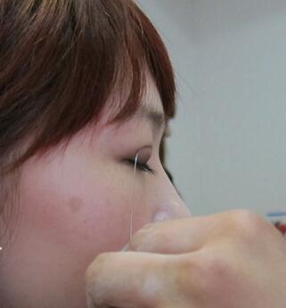 宜昌蕾帝整形張景雷雙眼皮面診