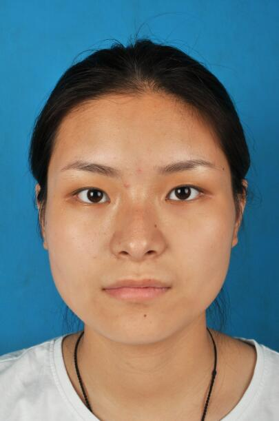 西安國(guó)際下頜角整形案例分享，怪不得都說(shuō)整形要先輪廓后五官