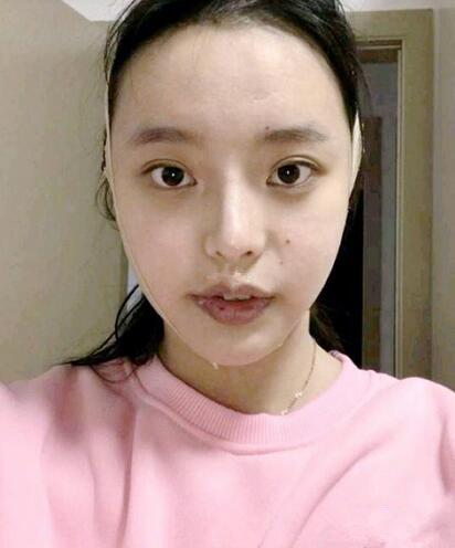 上海首爾麗格整形安建榮V-LINE瓜子臉手術一個月效果 上海首爾麗格整形安建榮V-LINE瓜子臉手術一個月效果