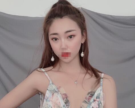 安徽省立醫(yī)院褚燕軍埋線雙眼皮一個月效果 安徽省立醫(yī)院褚燕軍埋線雙眼皮一個月效果