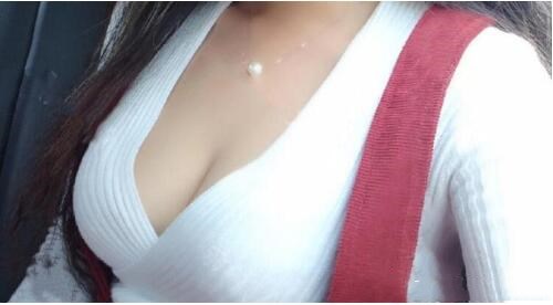 濟(jì)南悅美假體隆胸整形術(shù)后三個(gè)月效果