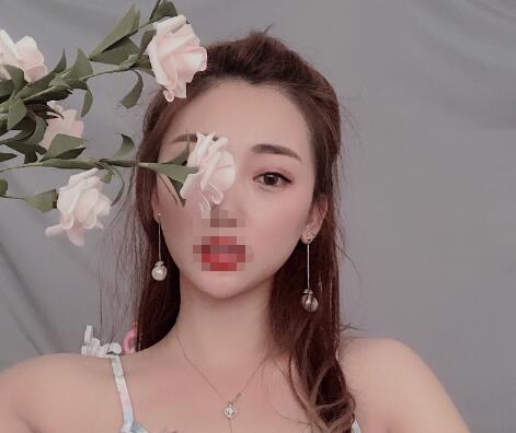 安徽省立醫(yī)院褚燕軍埋線雙眼皮一個月效果圖 安徽省立醫(yī)院褚燕軍埋線雙眼皮一個月效果圖