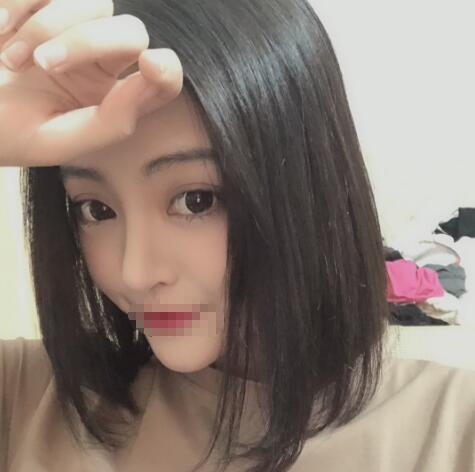 上海賽美瑞整形張化舉鼻綜合術(shù)后兩個(gè)月效果分享