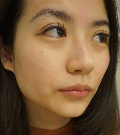 北京禾美嘉林善元激光祛斑術(shù)后一個(gè)月效果 北京禾美嘉林善元激光祛斑術(shù)后一個(gè)月效果