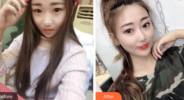 安徽省立醫(yī)院褚燕軍埋線雙眼皮前后對比圖 安徽省立醫(yī)院褚燕軍埋線雙眼皮前后對比圖