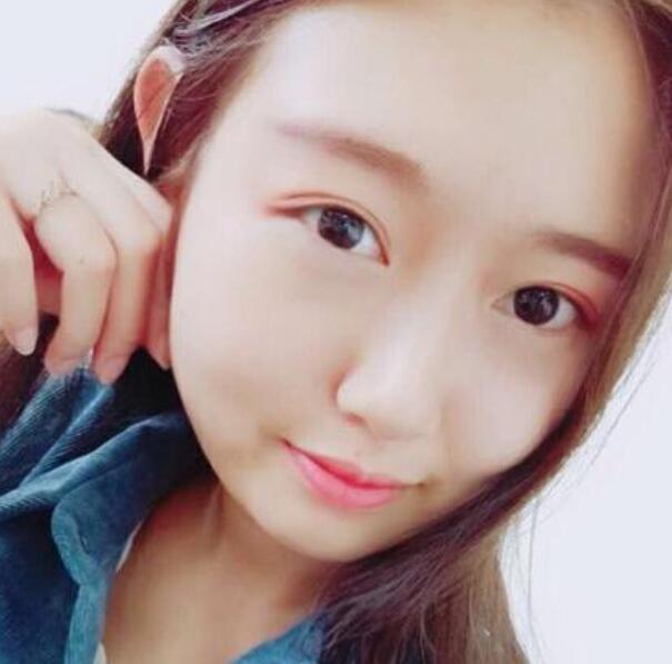 武漢伽美整形劉翼面部吸脂前效果