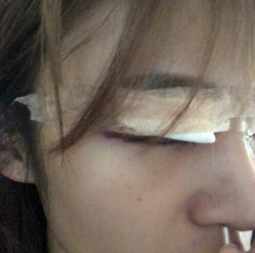 北京崔相平整形雙眼皮修復(fù)術(shù)后即刻 北京崔相平整形雙眼皮修復(fù)術(shù)后即刻
