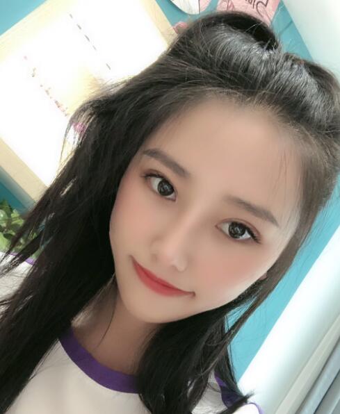 煙臺華怡整形張上海切開雙眼皮一個月效果