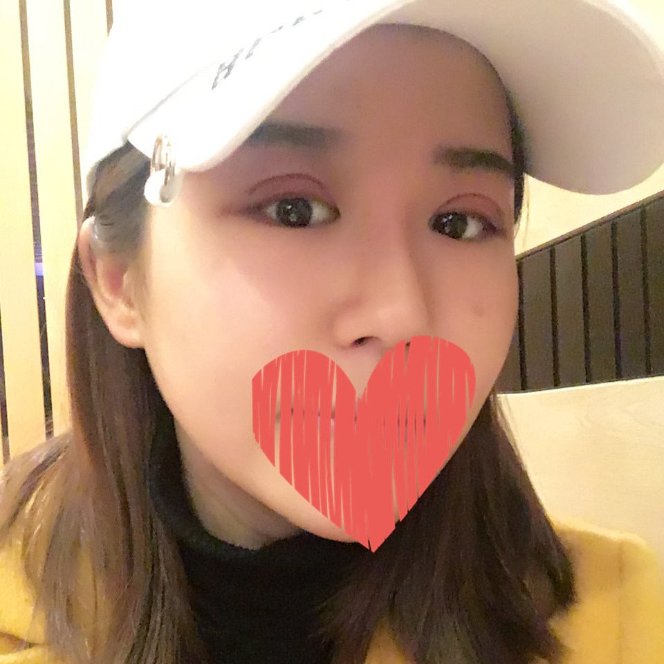 滄州中妤整形張明切開(kāi)雙眼皮拆線后三天效果 滄州中妤整形張明切開(kāi)雙眼皮拆線后三天效果