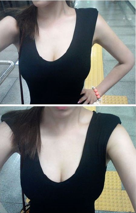 濟南鵬愛整形吳洪遠(yuǎn)復(fù)合隆胸案例分享