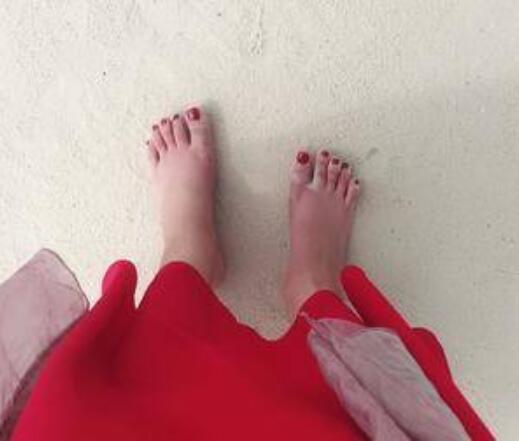 大同和平燒傷骨科醫(yī)院整形美容科大腳骨矯正術后三個月效果