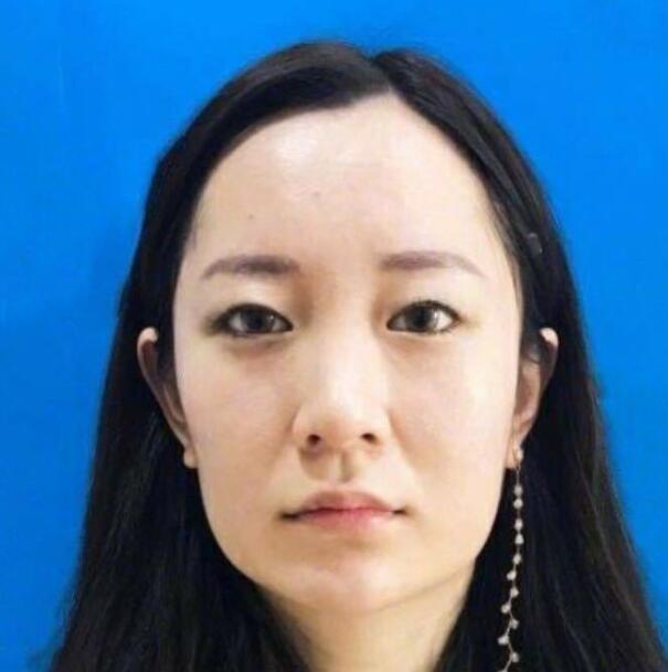 上海藝星整形崔海天下頜角整形術(shù)前效果