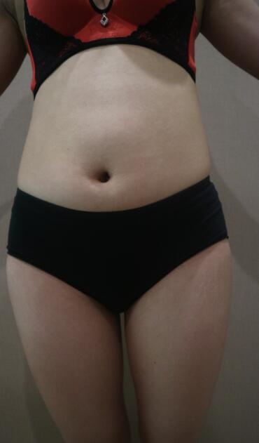 鄭州優(yōu)恩整形(原悅美)姚剛腿部吸脂前 鄭州優(yōu)恩整形(原悅美)姚剛腿部吸脂前