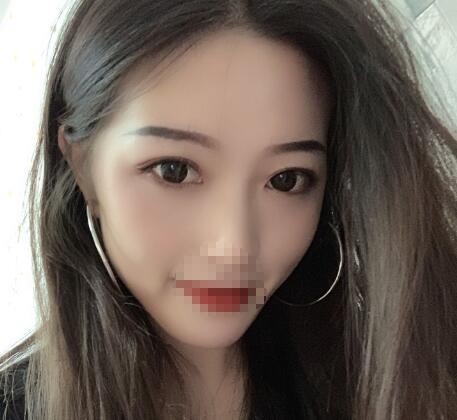 北京美萊整形杜園園雙眼皮三個(gè)月效果 北京美萊整形杜園園雙眼皮三個(gè)月效果