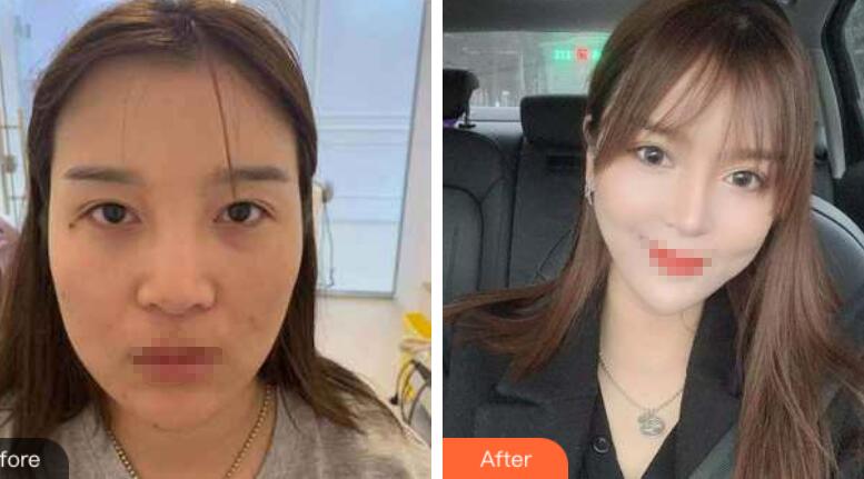 蘭州潤妍整形鼻綜合前后對比圖 蘭州潤妍整形鼻綜合前后對比圖