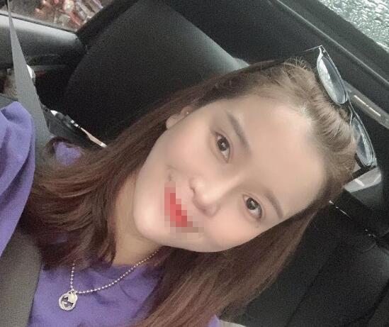 蘭州潤妍整形鼻綜合術(shù)后四十天效果 蘭州潤妍整形鼻綜合術(shù)后四十天效果