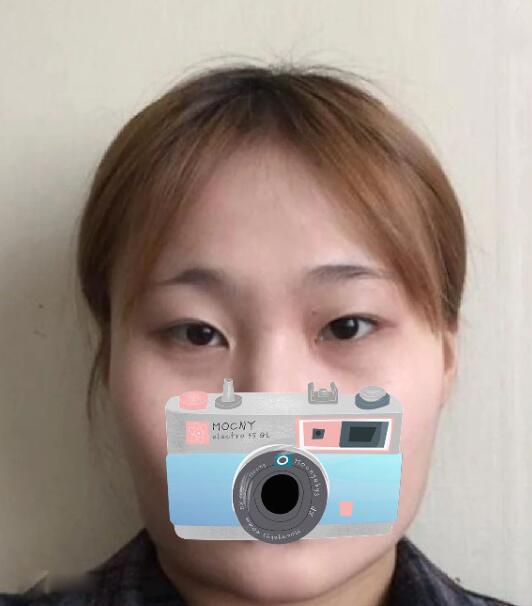 重慶華美整形下頜角整形術(shù)前效果 重慶華美整形下頜角整形術(shù)前效果