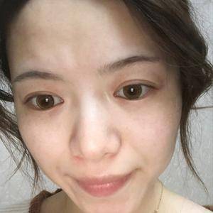 邯鄲佑熙整形孫堅激光祛斑半個月效果 邯鄲佑熙整形孫堅激光祛斑半個月效果