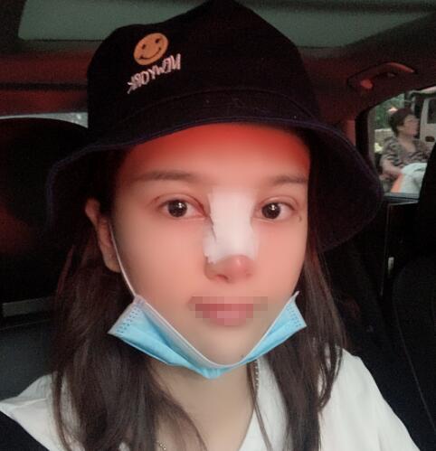 蘭州潤妍整形鼻綜合術(shù)后三天效果 蘭州潤妍整形鼻綜合術(shù)后三天效果