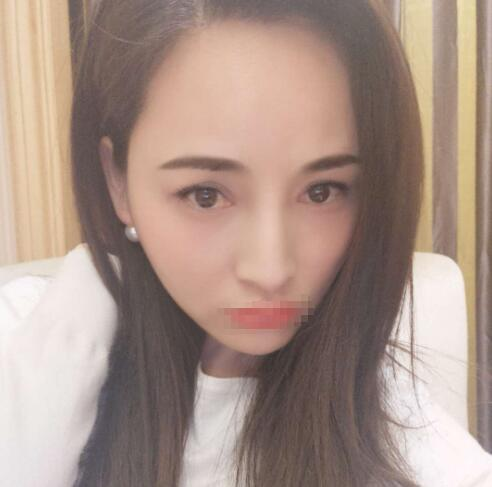 赤峰現(xiàn)代婦產(chǎn)醫(yī)院醫(yī)療美容科袁俊龍雙眼皮修復(fù)案例分享