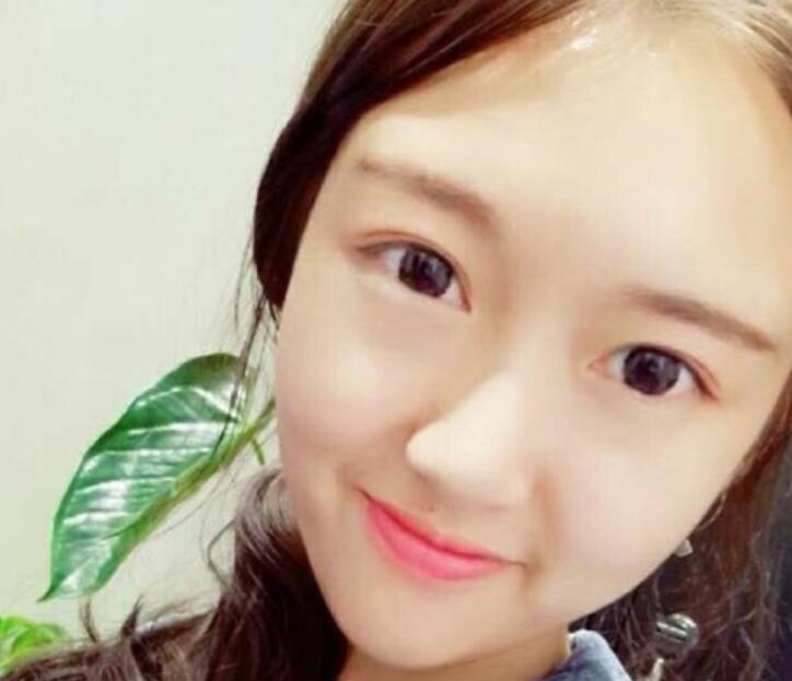 武漢伽美整形劉翼面部吸脂術后一個月效果