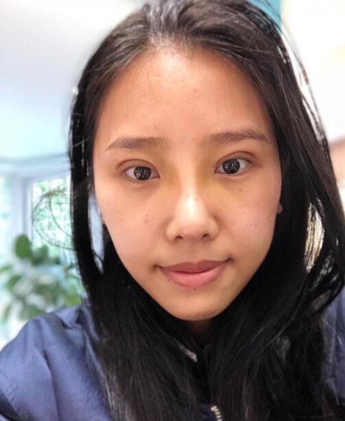 煙臺華怡整形張上海切開雙眼皮拆線后