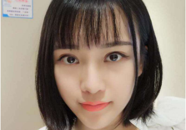 大連宏冠醫(yī)療雙眼皮修復(fù)后效果