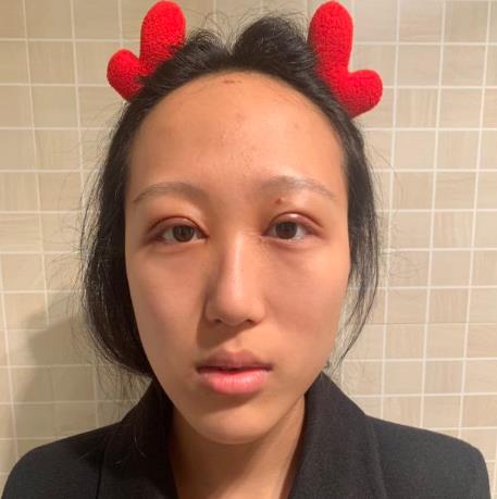 上海華美楊亞益眼部修復(fù)前效果圖 上海華美楊亞益眼部修復(fù)前效果圖
