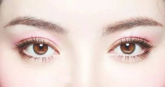 貴陽(yáng)華美整形美容埋線雙眼皮術(shù)后效果