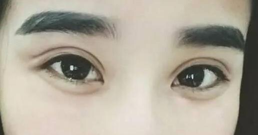 廣州愛來埋線雙眼皮手術(shù)后的效果