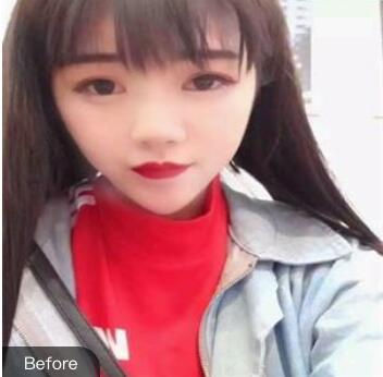 做注射隆鼻前的效果