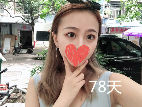 杭州靜港林忠泵埋線雙眼皮案例1-7天效果圖分享，讓你的眼睛魅力四射