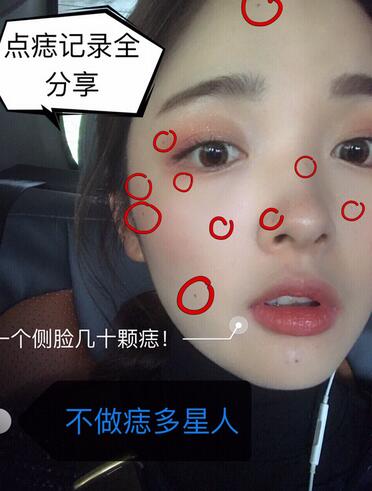 做激光點(diǎn)痣之前的效果