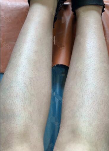 宋君醫(yī)生激光脫毛案例 宋君醫(yī)生激光脫毛案例