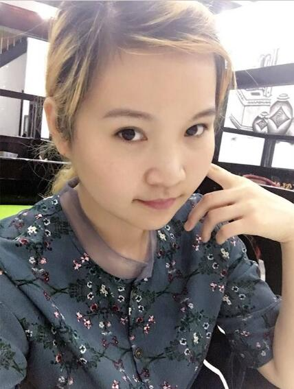 廈門華美名媛整形醫(yī)生賈虹下頜角削骨案例效果對(duì)比圖！