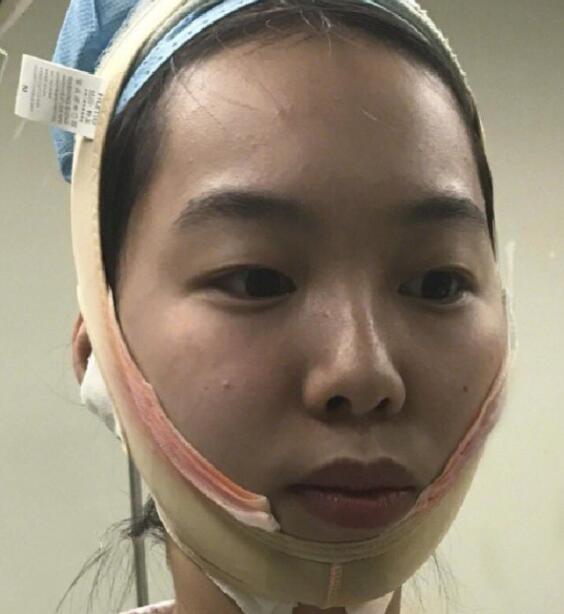 下頜角截骨手術(shù)中