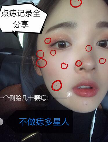 北京蕾士悅丁香醫(yī)生激光點痣案例效果分享