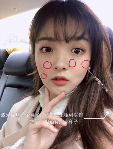 北京蕾士悅丁香醫(yī)生激光點痣案例效果分享