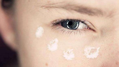 青島秋韻風(fēng)疤痕整形?？漆t(yī)院激光祛眼袋