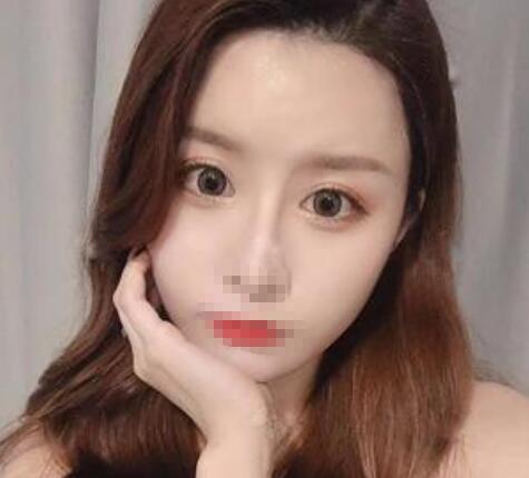 完全恢復后的雙眼皮效果