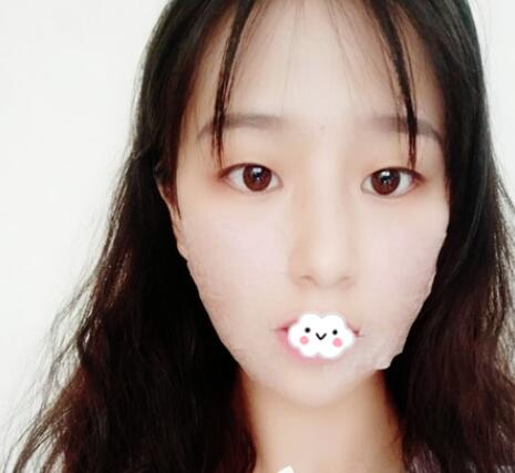 北京玲瓏梵宮整形醫(yī)生張蔚宣下頜角案例100天效果對比圖