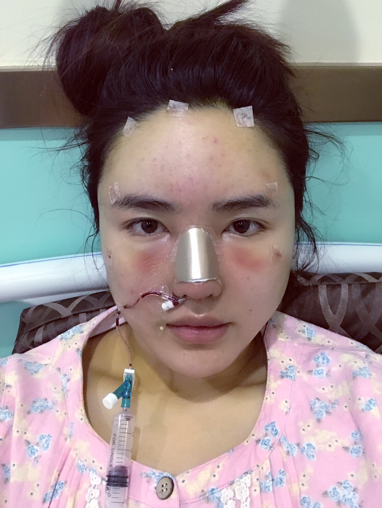 膨體隆鼻手術(shù)過程 膨體隆鼻手術(shù)過程