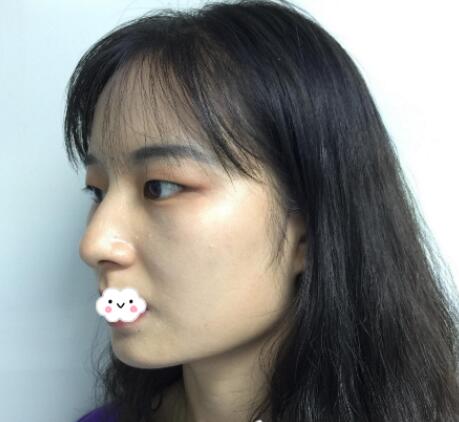 尖下頜角整形介紹