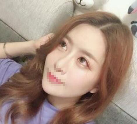 鄭州風信子整形醫(yī)院雙眼皮案例