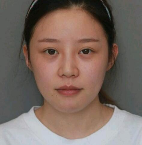 亳州華美整形美容醫(yī)院李劍醫(yī)生玻尿酸豐下巴案例效果分享