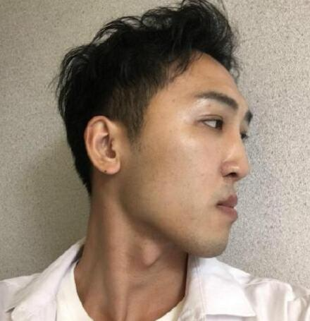 成都恩喜醫(yī)學(xué)整形張曉琴醫(yī)生男性過大下頜角磨骨案例效果分享